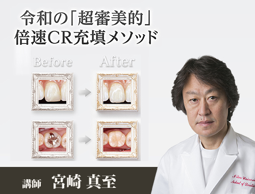 令和の「超審美的」倍速CR充填メソッド